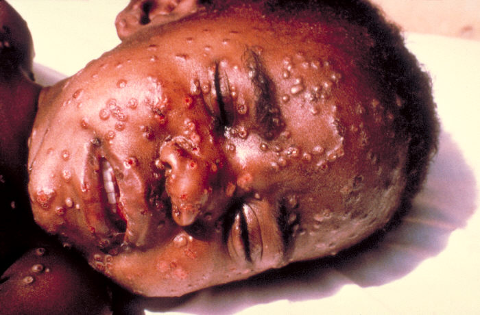 child with smallpox